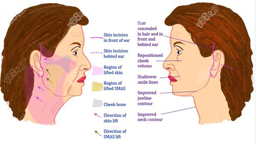 面部提升手術(shù)對(duì)比圖
