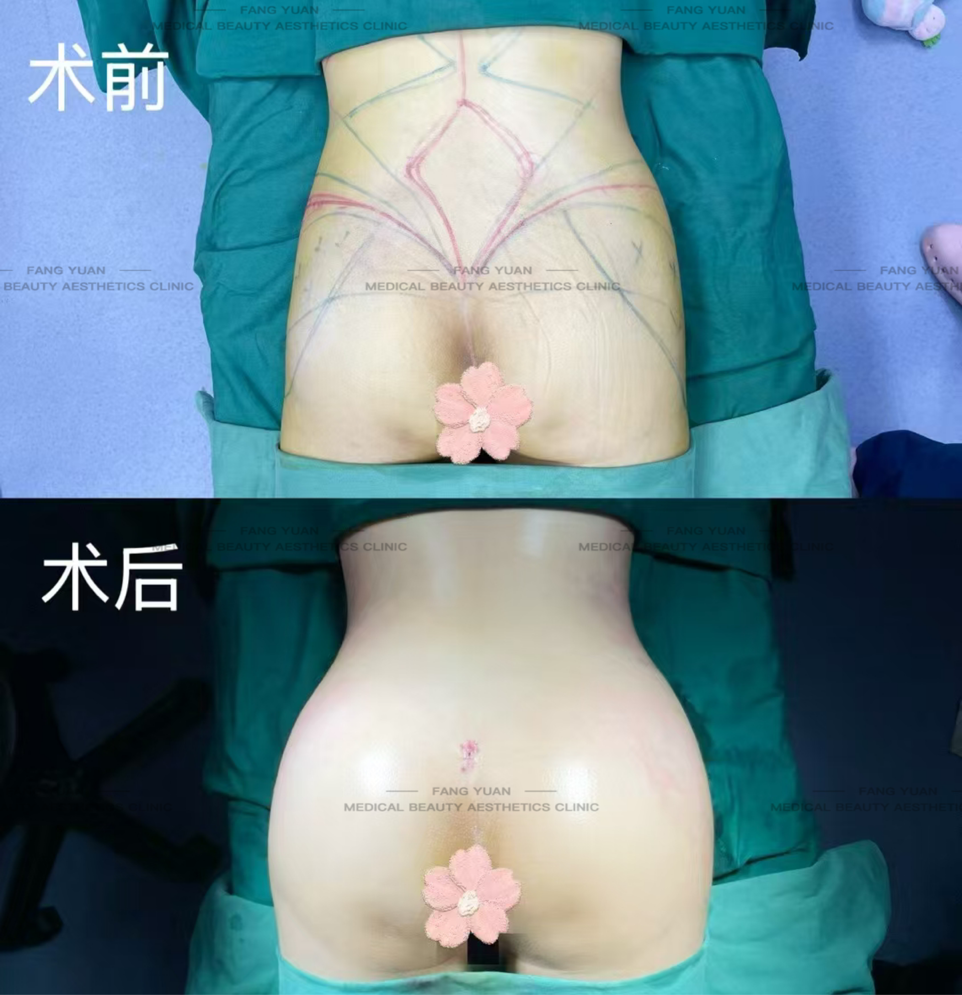 合肥周瑜修復(fù)降肌：患者口碑杠杠的