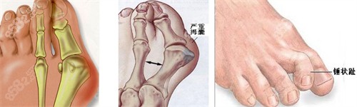 大腳骨的表現(xiàn) 大腳骨的表現(xiàn)