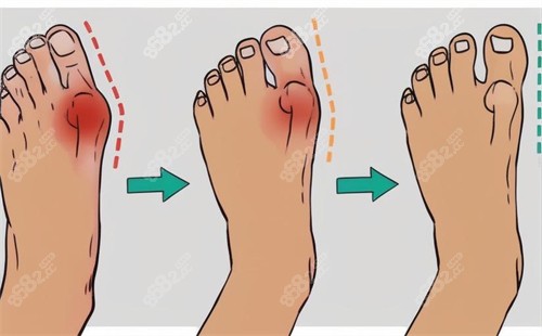 拇外翻手術(shù)修復(fù)動(dòng)畫圖 拇外翻手術(shù)修復(fù)動(dòng)畫圖