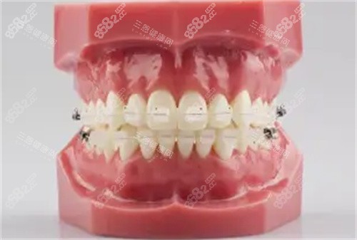 半隱形矯正牙齒模具圖 半隱形矯正牙齒模具圖