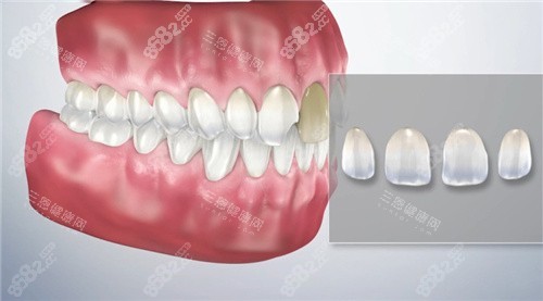 牙齒貼面預(yù)想圖 牙齒貼面預(yù)想圖