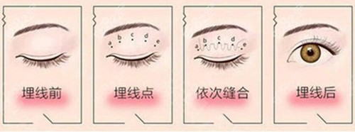 埋線雙眼皮過程示意圖片 埋線雙眼皮過程示意圖片