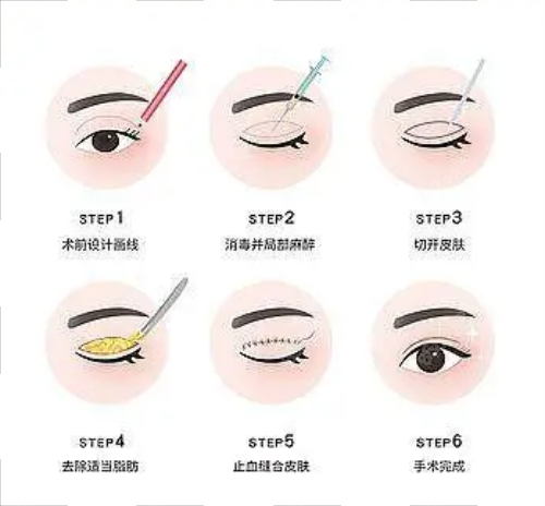 全切雙眼皮流程圖示 全切雙眼皮流程圖示