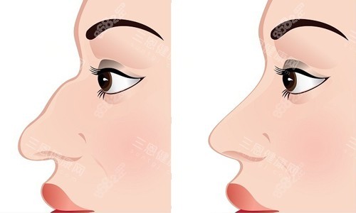 鼻整形前后對比