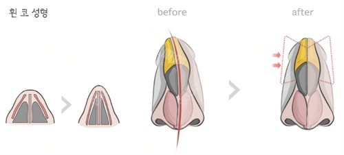 鼻整形前后對比圖一覽