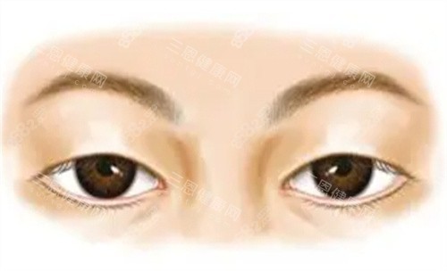未做手術(shù)前的上眼瞼下垂