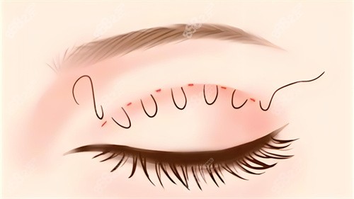 雙眼皮埋線圖 雙眼皮埋線圖