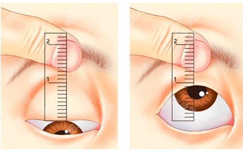 眼瞼是否下垂自測圖