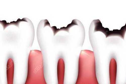 牙齒齲壞不同程度卡通示意圖 牙齒齲壞不同程度卡通示意圖