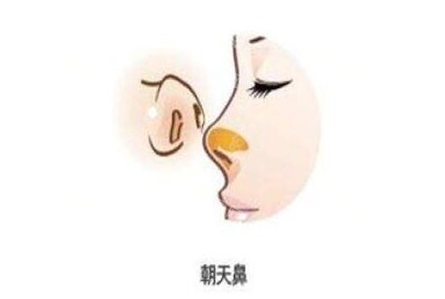 朝天鼻整形手術