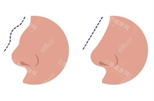 修復(fù)失敗鼻子前后對(duì)比圖