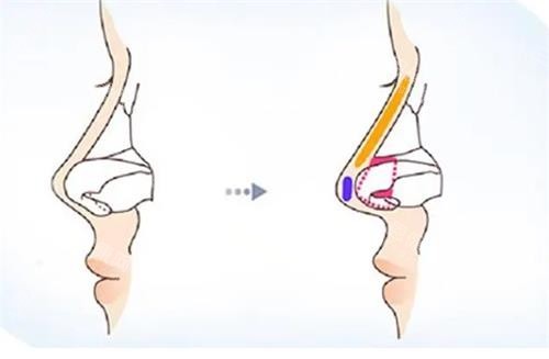 鼻小柱延長(zhǎng)前后對(duì)比圖