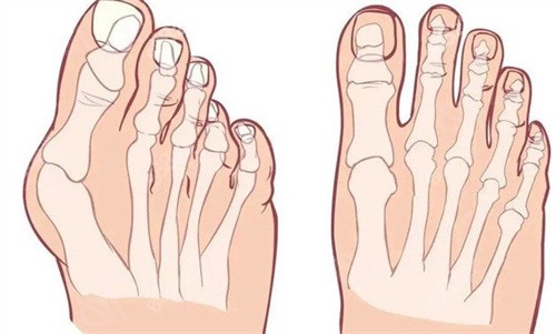 大腳骨的腳和正常對(duì)比 大腳骨的腳和正常對(duì)比