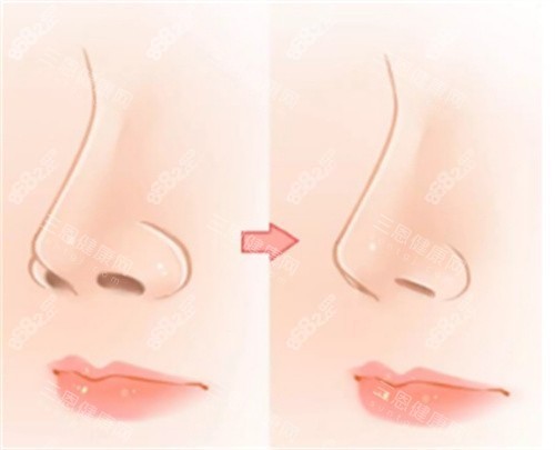 鼻翼縮小整形手術(shù)