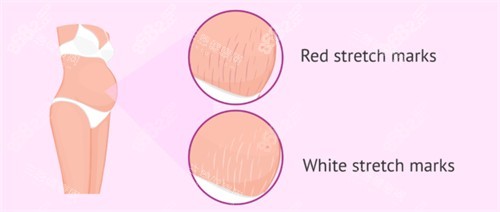 妊娠紋疤痕漫畫圖疤痕