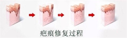 疤痕修復過程圖