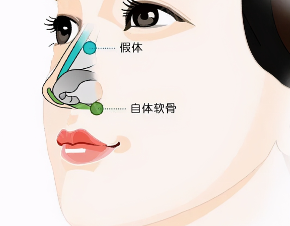 貴陽杜良軍鼻整形風(fēng)格大解析
