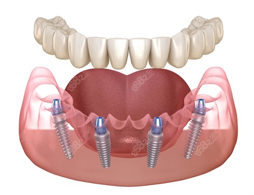 半口種植牙動畫圖示 半口種植牙動畫圖示