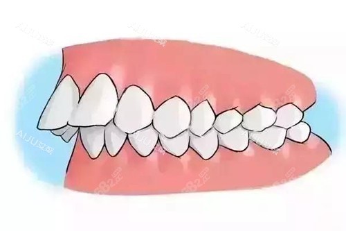 深覆合牙齒突出卡通示意圖