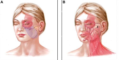 面部提升手術(shù)改善部位 面部提升手術(shù)改善部位