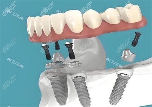 種植牙圖片展示圖 種植牙圖片展示圖