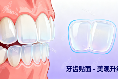 牙齒貼面美白牙齒卡通圖