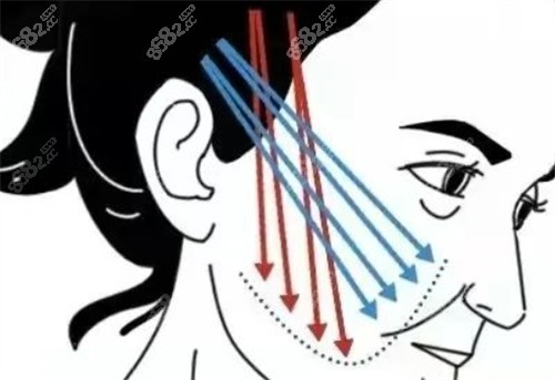 中下面面部提升的位置 中下面面部提升的位置