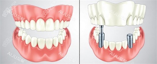 種植牙前后動畫 種植牙前后動畫