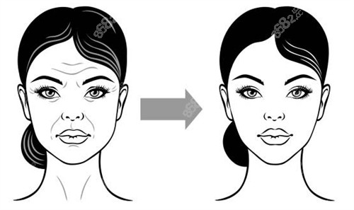 面部提升手術(shù)改善面部皺紋