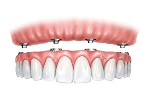 全口種植牙圖示