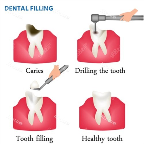 修復(fù)齲壞的牙齒