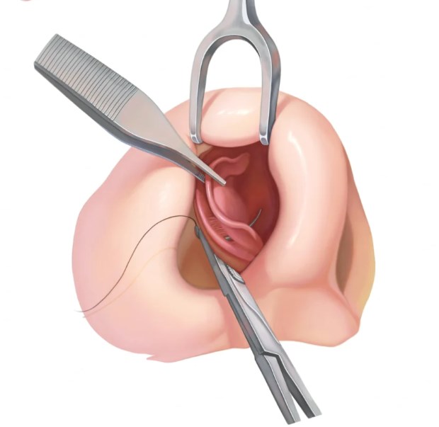 一、從鼻部基礎(chǔ)條件看成都周順波鼻整形風(fēng)格的適配性www.sorencai.cn