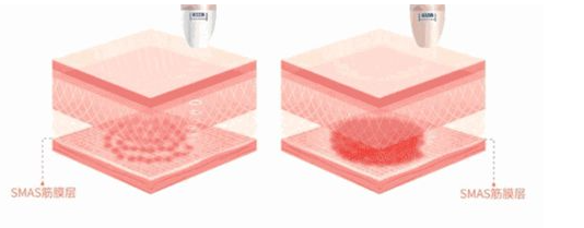 聚拉美超聲炮成效咋樣？