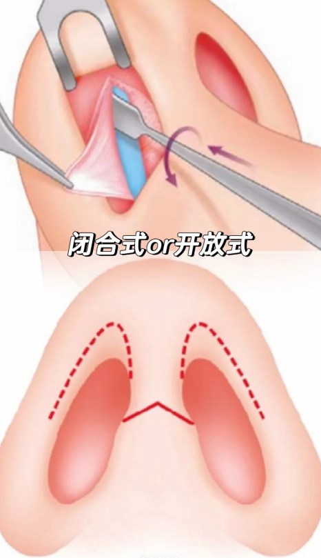 人工骨隆鼻有被我國批準嗎？合法材料的選擇標準