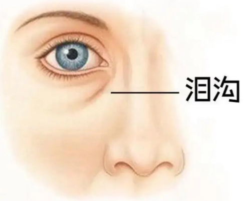 郭鑫醫(yī)生自體脂肪填充淚溝、影響因素