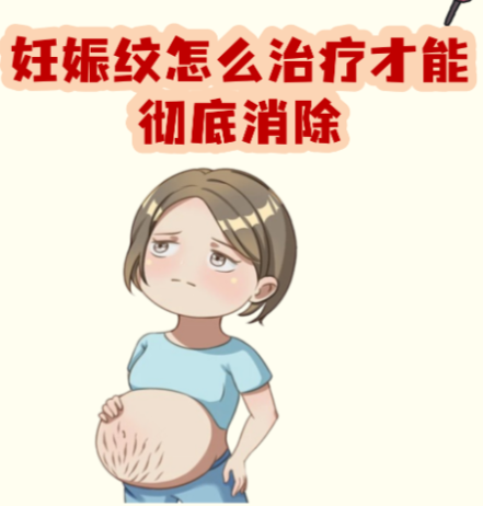 点阵激光去妊娠纹的价格参考与疗程规划