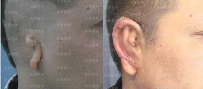 舒茂國(guó)唇裂修復(fù)：術(shù)后成效與患者反饋良好