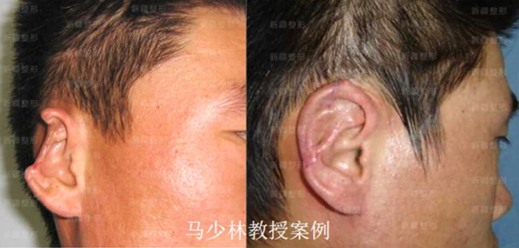 舒茂國(guó)唇裂修復(fù)：坐診醫(yī)院實(shí)力雄厚