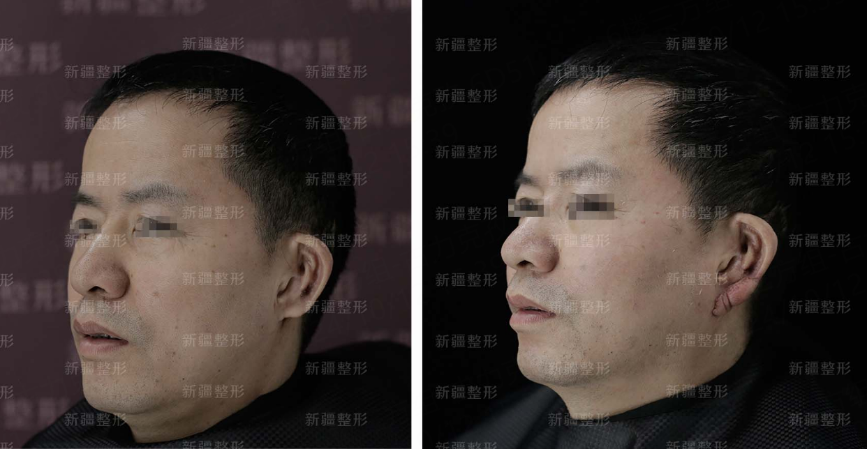 舒茂國(guó)唇裂修復(fù)：預(yù)約指南要知曉