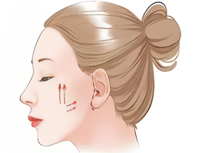 廣州華美林曉燕拉皮手術(shù)怎么樣？