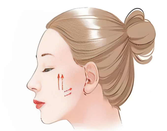  35歲大拉皮手術(shù)