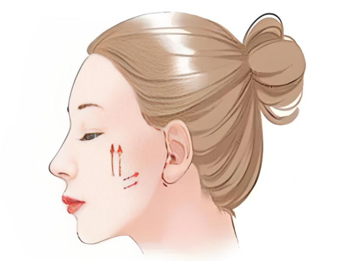 急性腫脹期（術(shù)后1 - 3天）