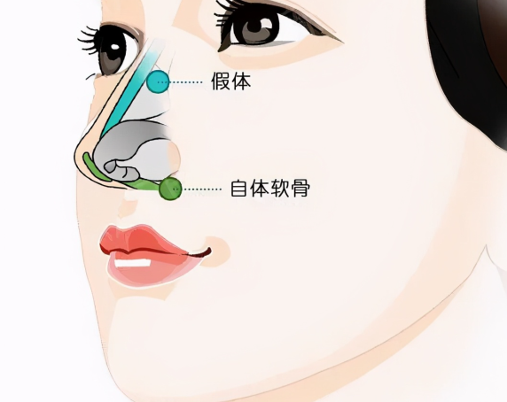 擅長(zhǎng)領(lǐng)域?qū)Ρ?></figure><h3><strong>三、醫(yī)生口碑對(duì)比</strong></h3><p><strong>戴傳昌</strong>：在鼻整形領(lǐng)域是大師級(jí)的存在，他的技術(shù)實(shí)力得到了行業(yè)內(nèi)的公認(rèn)。很多患者都慕名而來，希望能得到他的治療。然而，由于他有名度大、人氣高，平時(shí)工作非常繁忙，導(dǎo)致不管是面診還是手術(shù)都很難預(yù)約。而且在面診過程中，可能因?yàn)闀r(shí)間有限，相對(duì)會(huì)比較匆忙，不夠細(xì)致。www.868=2.cc但這并不影響他在患者心中的地位，很多患者在接受他的手術(shù)后，對(duì)手術(shù)療效都非常滿意，認(rèn)為雖然面診時(shí)間短，但手術(shù)療效確實(shí)達(dá)到了預(yù)期。</p><p><strong>陳付國</strong>：從他的擅長(zhǎng)領(lǐng)域和在上海的工作經(jīng)歷來看，他也有自己的一批忠實(shí)患者。在全軟骨鼻修復(fù)方面有專長(zhǎng)的他，會(huì)受到那些對(duì)軟骨鼻修復(fù)有需求患者的青睞。</p><figure class=