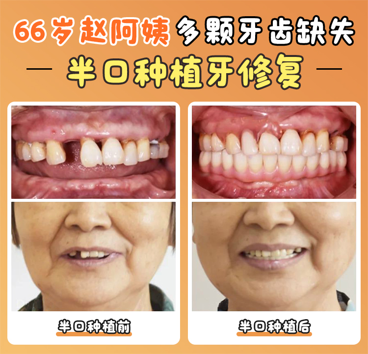 牙齒矯正項(xiàng)目?jī)r(jià)格一覽