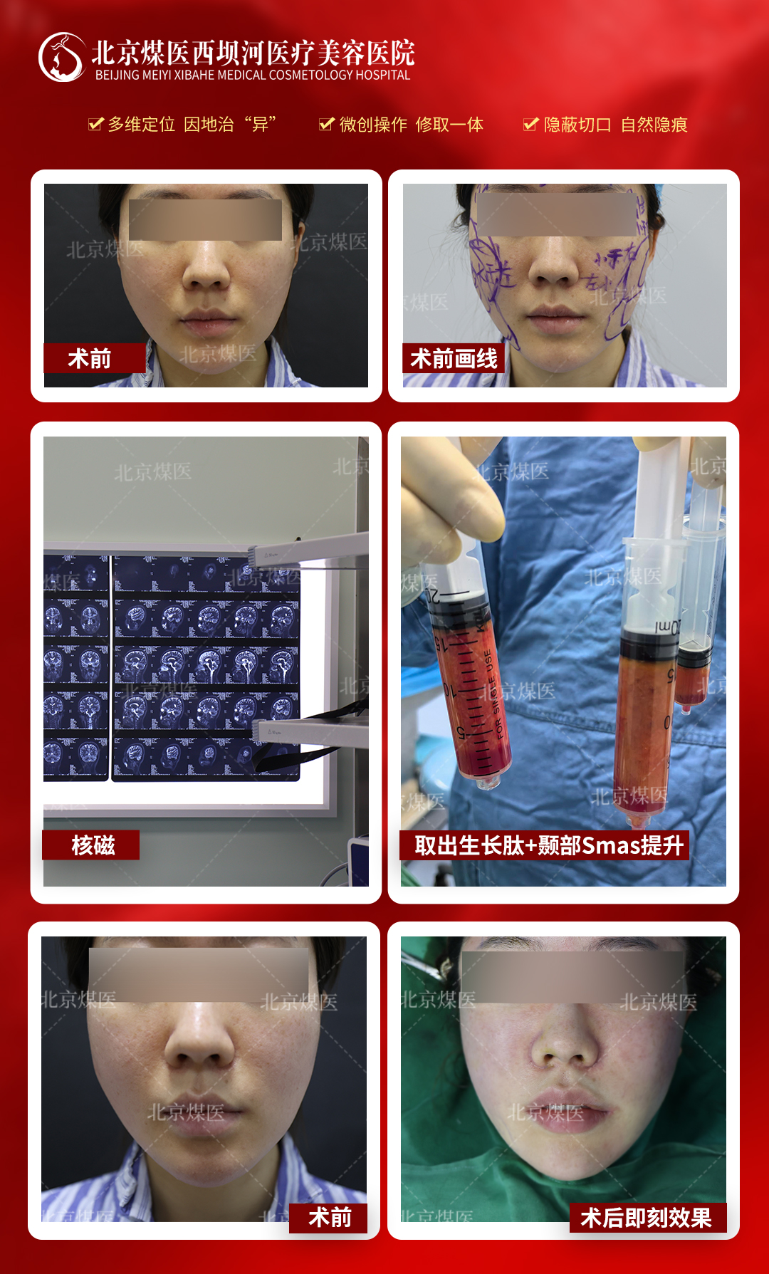 一、上海奧美定取出醫(yī)生推薦www.sorencai.cn