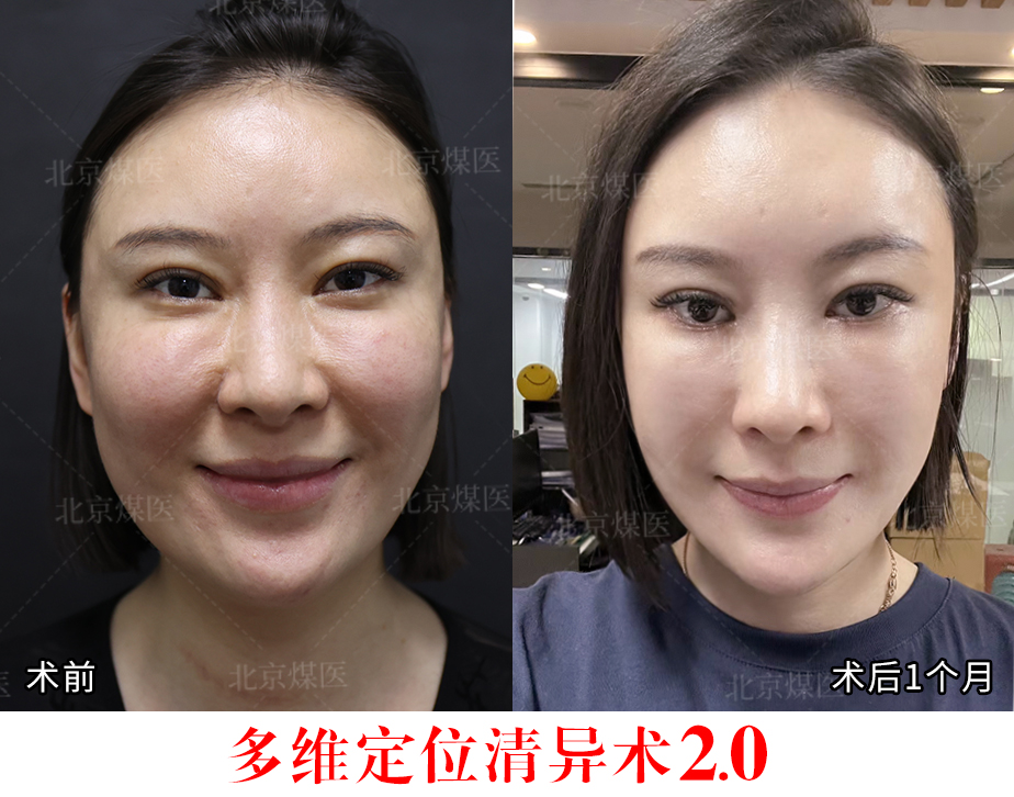 二、上海華美李健醫(yī)生的清奧技術(shù)解析