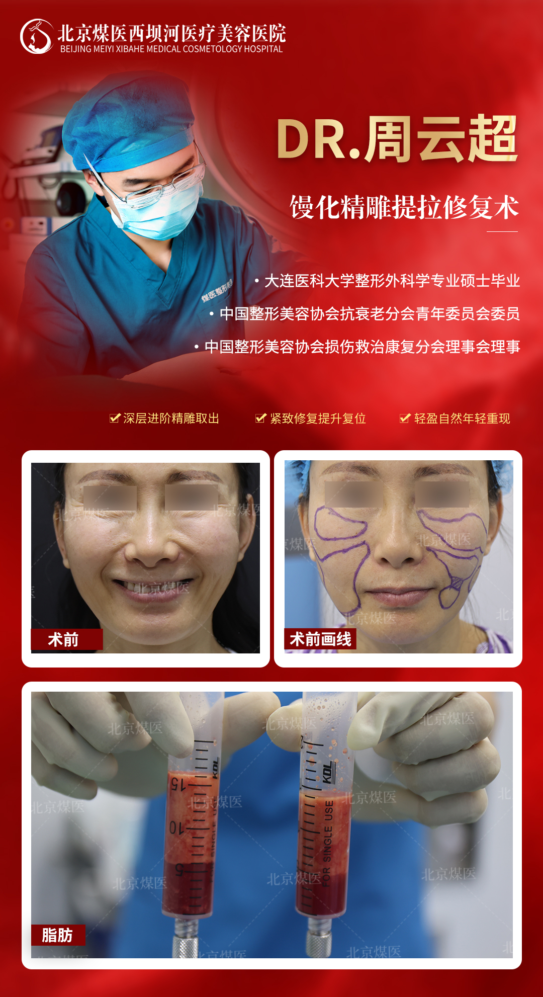 三、上海美萊李旭東醫(yī)生的清奧技術(shù)解析