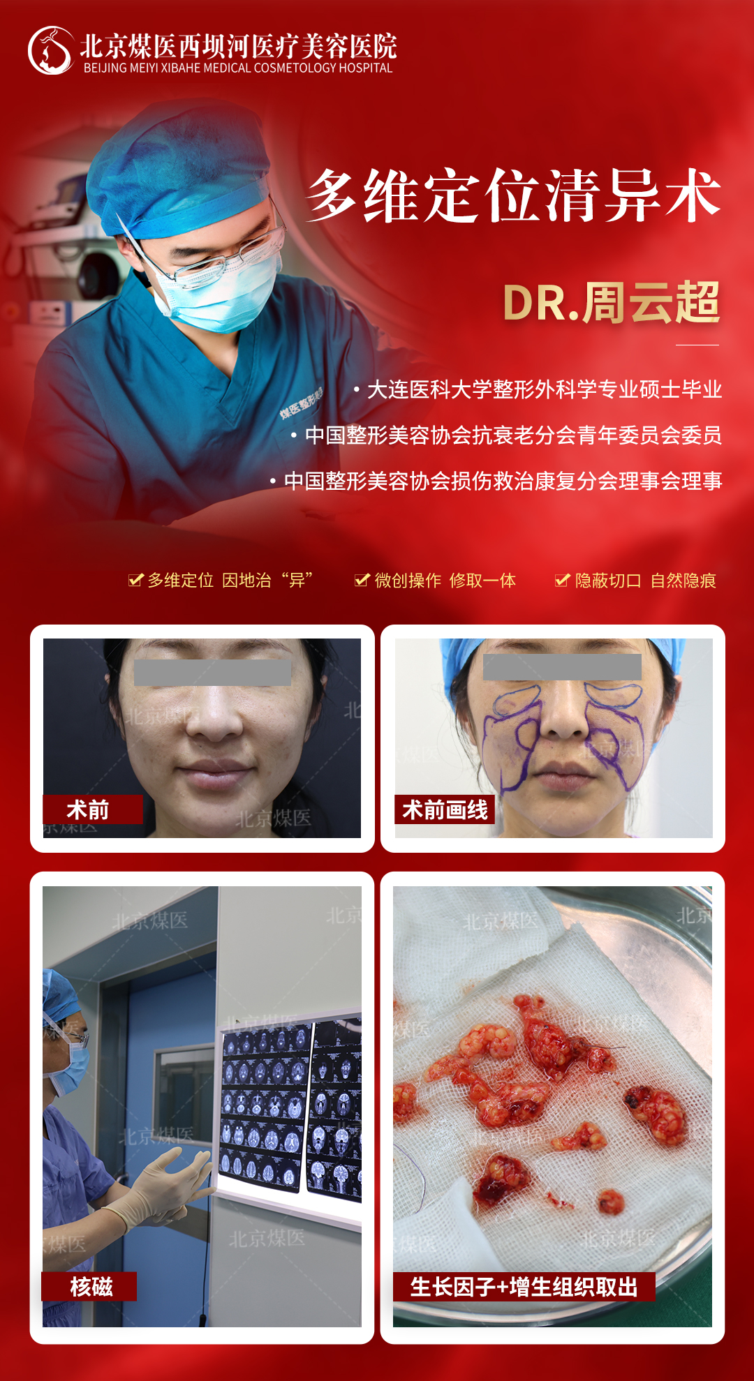 四、上海奧美定取出醫(yī)生選擇的注意事項