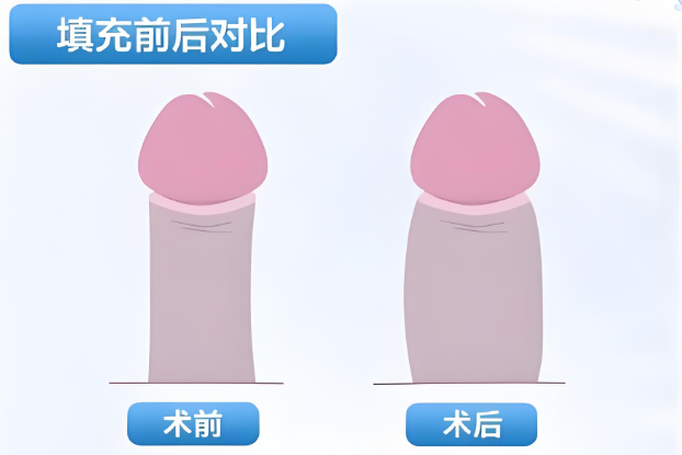 四、龍氏陰莖手術與陰莖假體手術有什么區(qū)別？